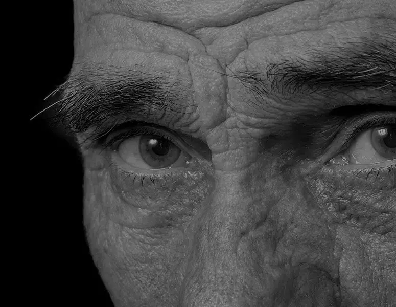 Dry Macula Degeneration (Dry AMD)