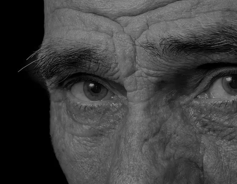 Dry Macula Degeneration (Dry AMD)
