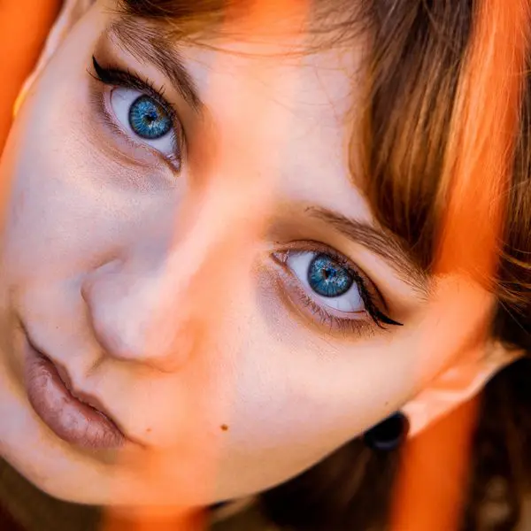 Keratoconus