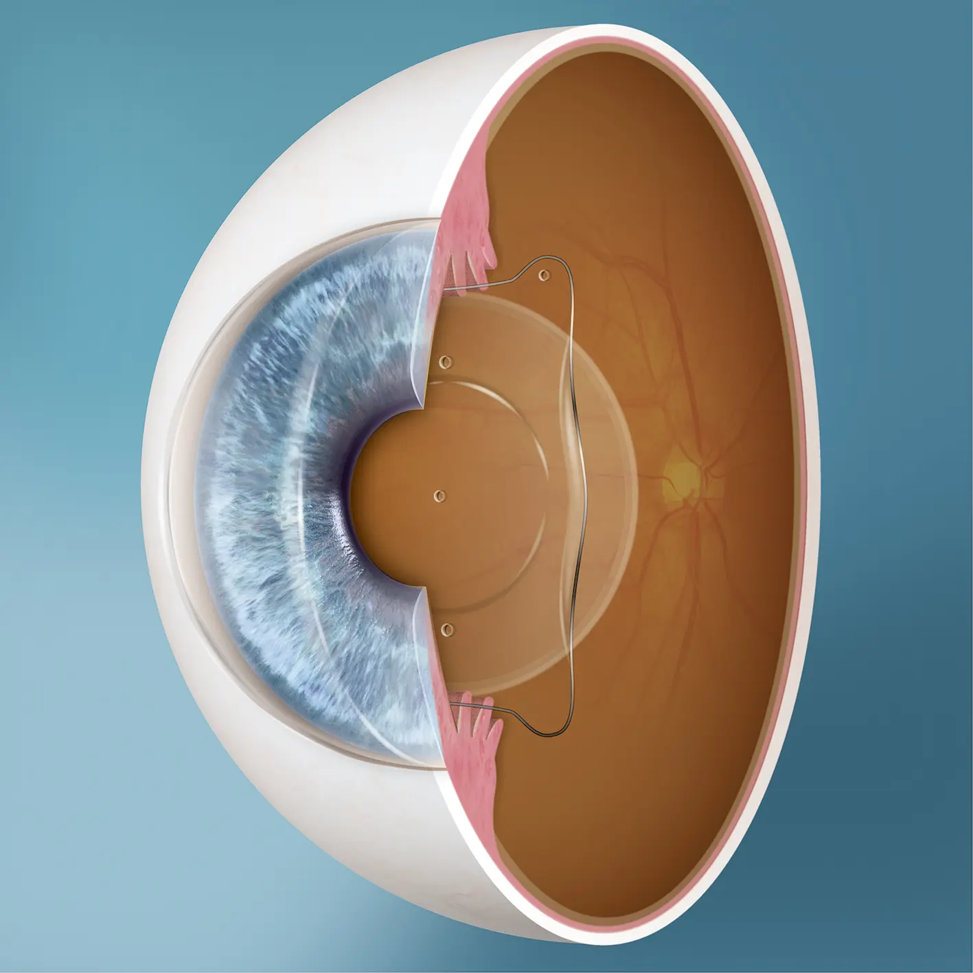 How is ICL surgery performed?
