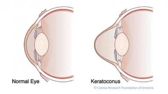 Eye Condition Focus: Keratoconus