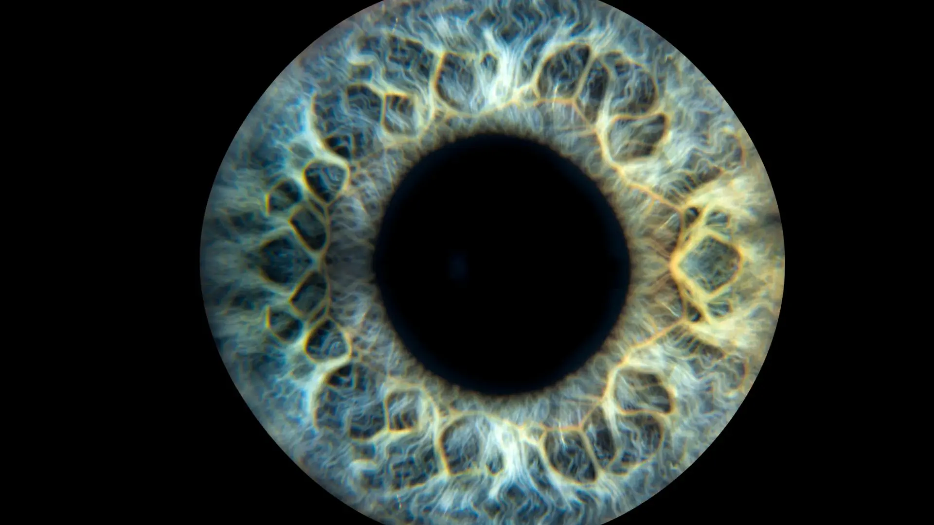 Epiretinal Membrane Treatment