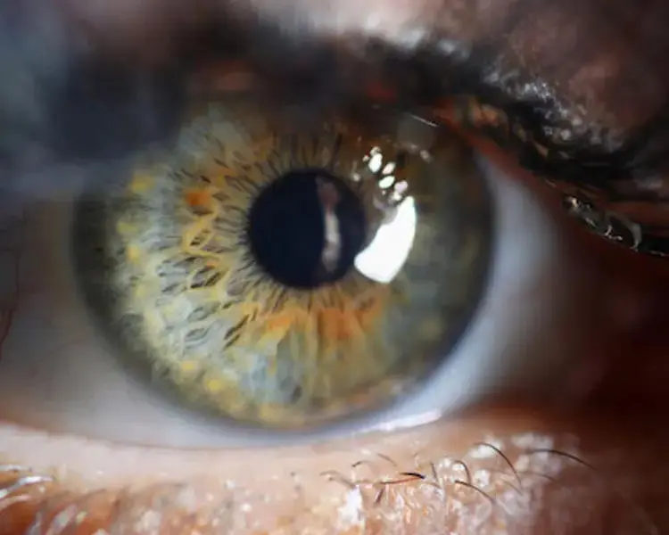 Is Laser Eye Surgery Permanent?