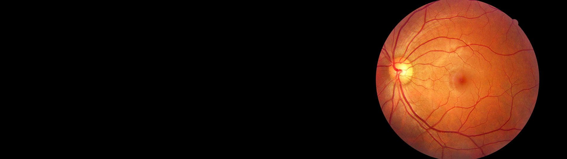 Epiretinal Membrane