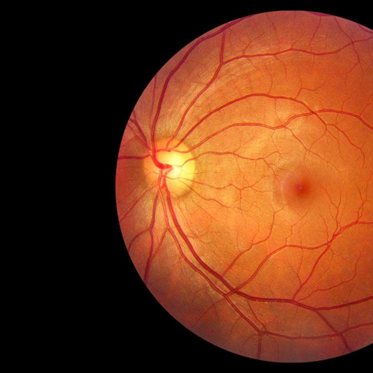 Epiretinal Membrane