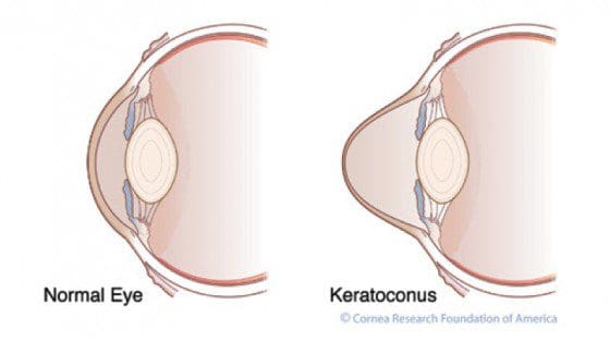 Eye Condition Focus: Keratoconus