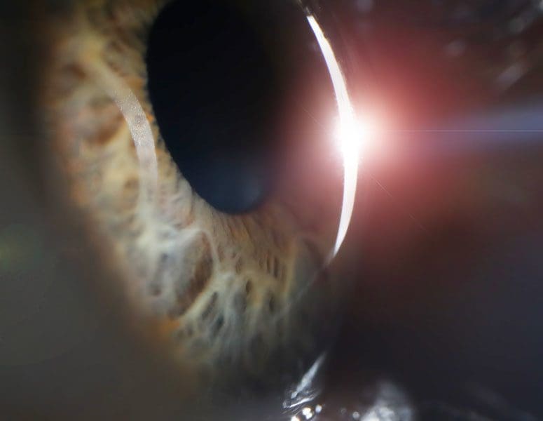 The Pros and Cons of Cataract Surgery