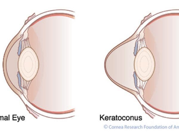 Eye Condition Focus: Keratoconus