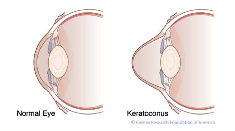 keratoconus, eye conditions, symptoms, cause, diagnosis, treatment, cure,