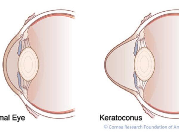Cross-linking Can Halt the Progression of Keratoconus