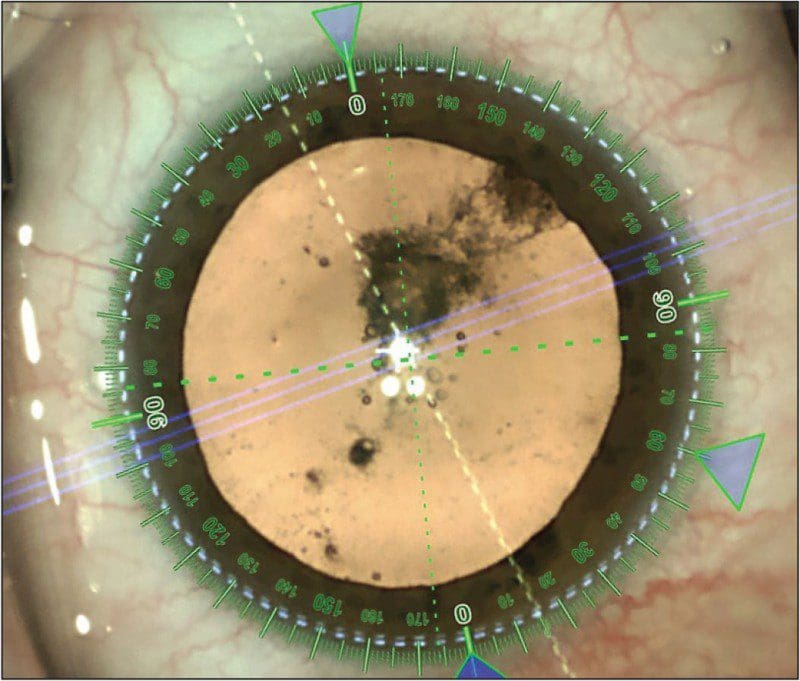 Cataract Surgery in Guildford