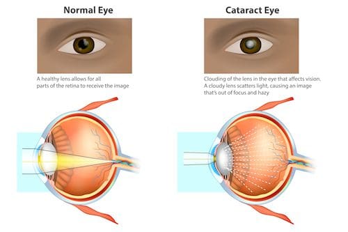 Laser Cataract Surgery LaserVision Surrey